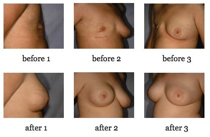 breast reconstruction surgery before and after