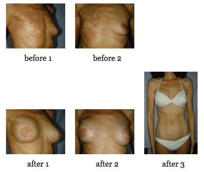 breast reconstruction surgery before and after