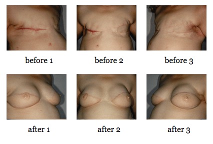 breast reconstruction surgery before and after