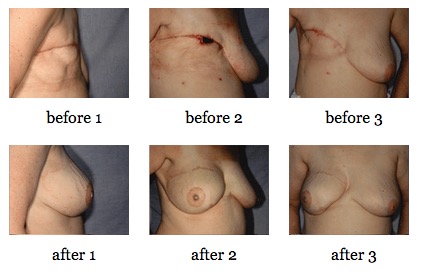 breast reconstruction surgery before and after