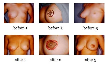 breast reconstruction surgery before and after