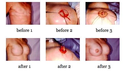 breast reconstruction surgery before and after