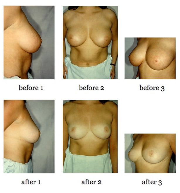 breast-lift-8