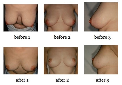 breast reduction before and after