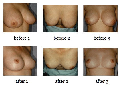 breast reduction before and after
