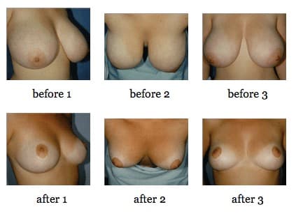 breast reduction before and after