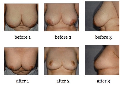 breast reduction before and after