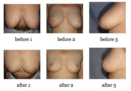 breast reduction before and after