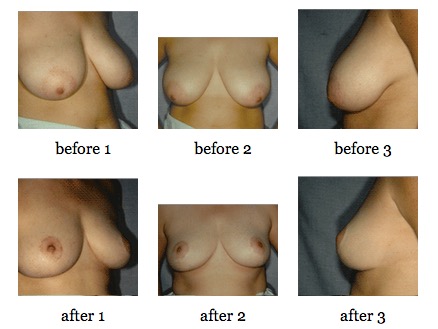 breast reduction before and after