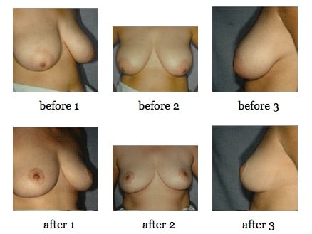 breast reduction before and after