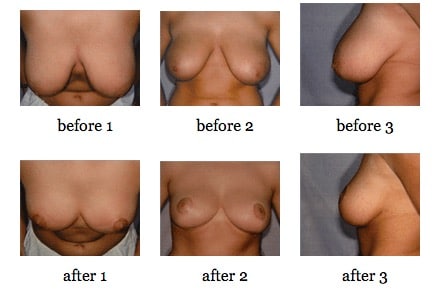 breast reduction before and after