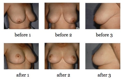 breast reduction before and after