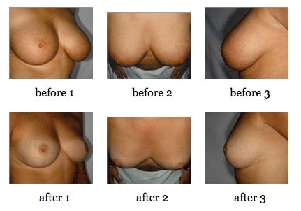 breast reduction before and after