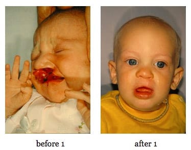 cleft-lip-repair