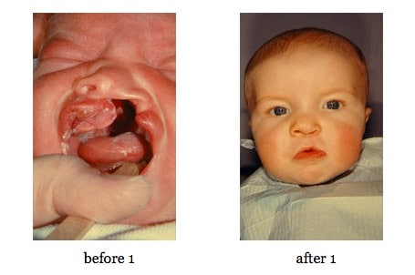 cleft-lip-repair2