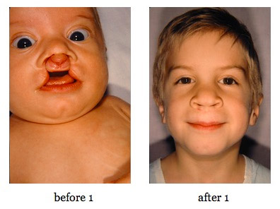 cleft-lip-repair3