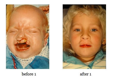 cleft-lip-repair4