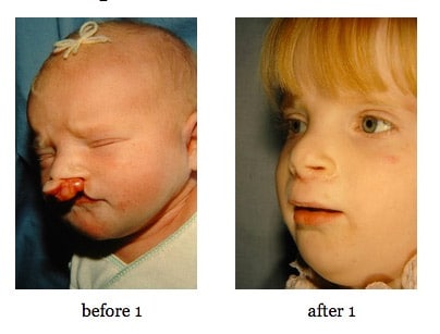 cleft-lip-repair5