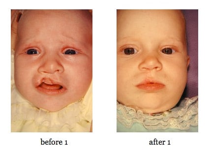 cleft-lip-repair6