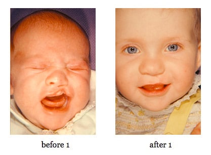 cleft-lip-repair7