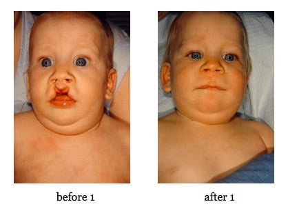 cleft-lip-repair8