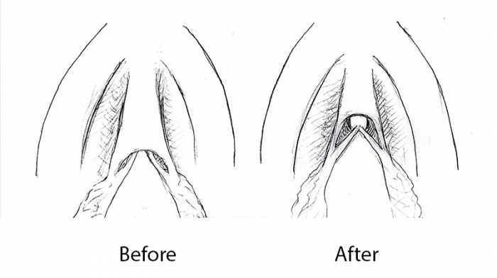 excessive clitoral hooding