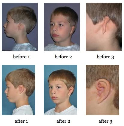 Ear Reconstruction before and after