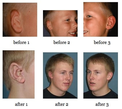 Ear Reconstruction before and after