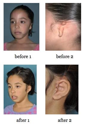 Ear Reconstruction before and after