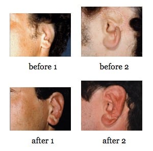 Ear Reconstruction before and after