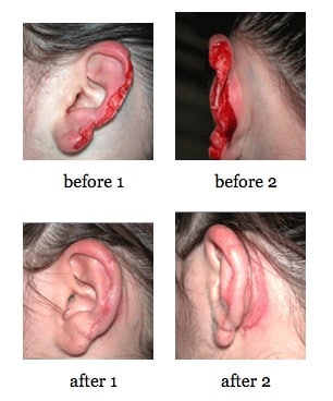 Ear Reconstruction before and after