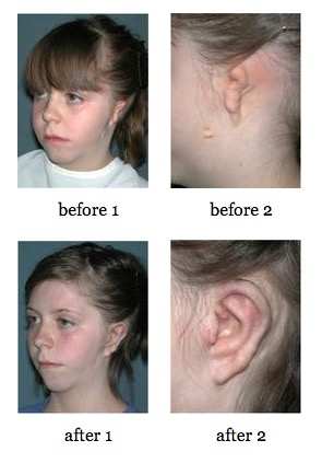 Ear Reconstruction before and after