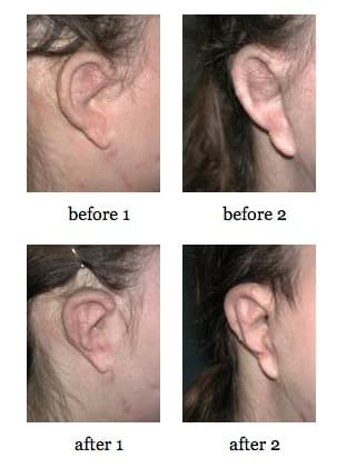 Ear Reconstruction before and after