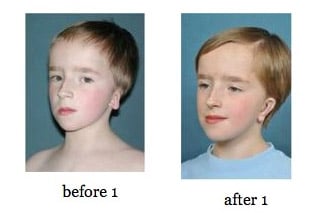 ear-reconstruction13