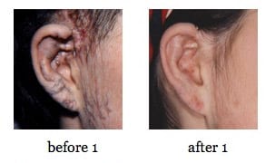 ear-reconstruction6