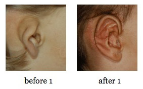 ear-reconstruction7