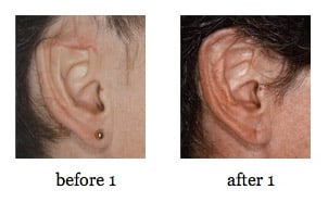 ear-reconstruction8