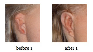 ear-reconstruction9