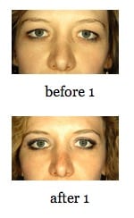 EyeLid Lift before and after