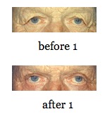 EyeLid Lift before and after