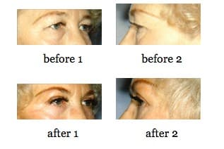 EyeLid Lift before and after