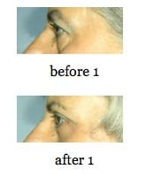 EyeLid Lift before and after