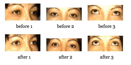 EyeLid Lift before and after