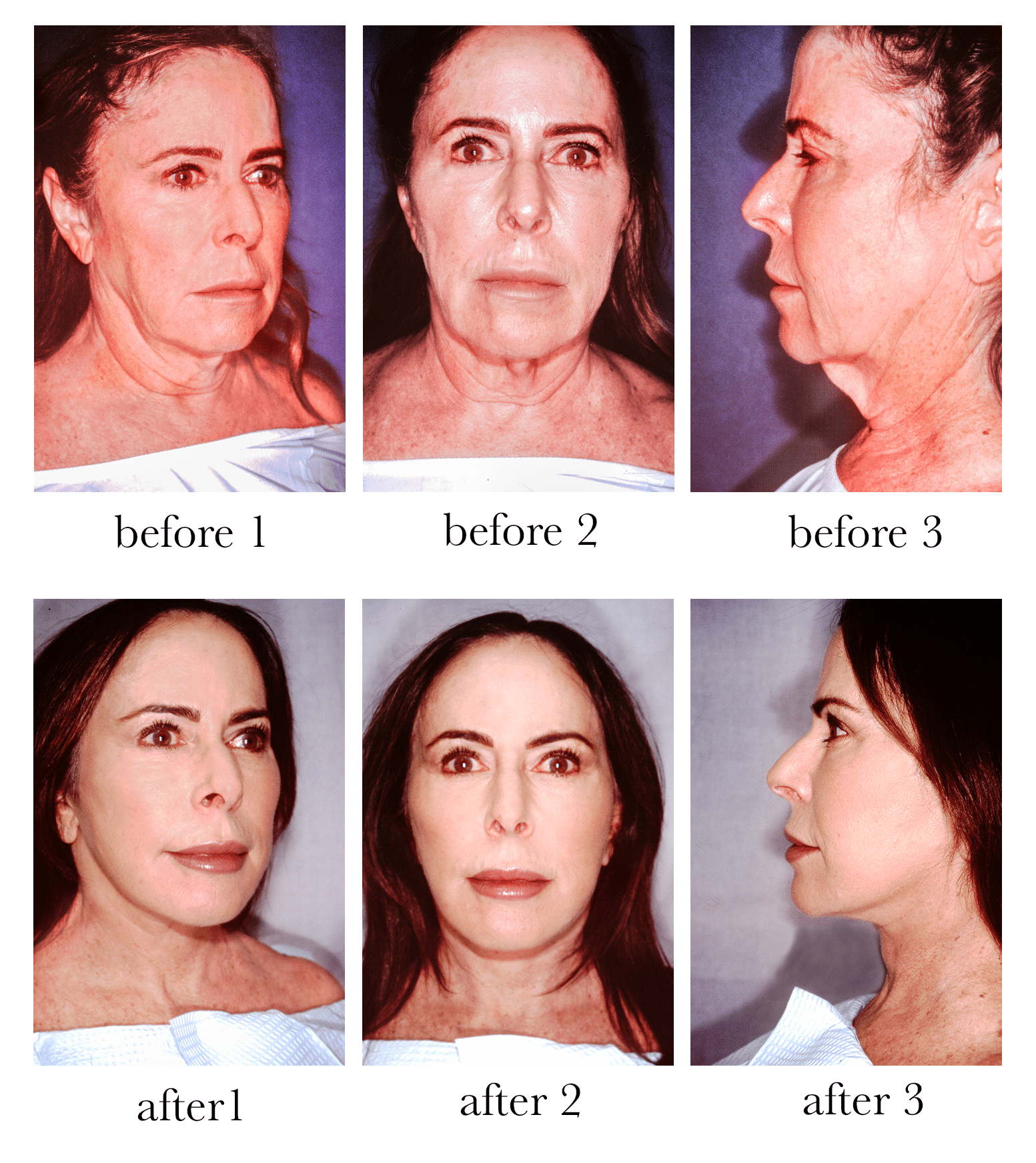 Facelift Deep Plane Salt Lake City Fairbanks Plastic Surgery Center