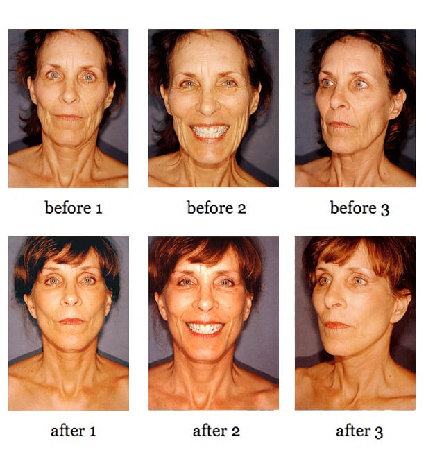 facelift before and after