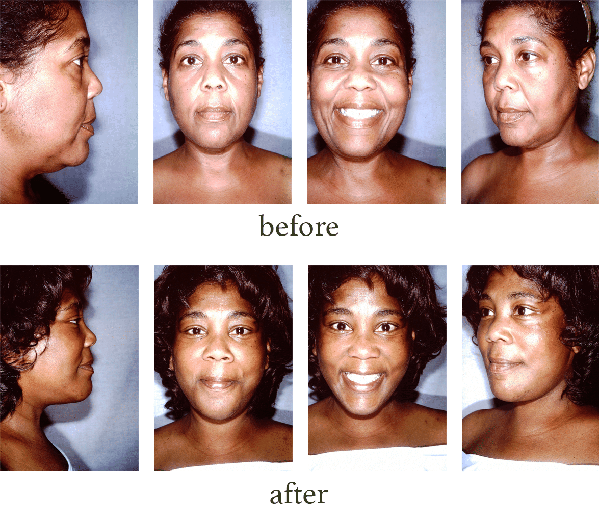 Before and after pictures of a facelift procedure