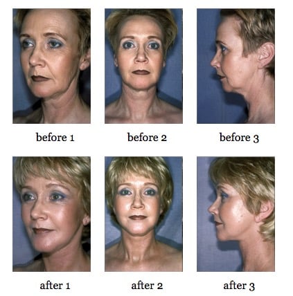 facelift before and after