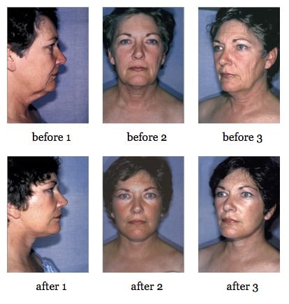 facelift before and after