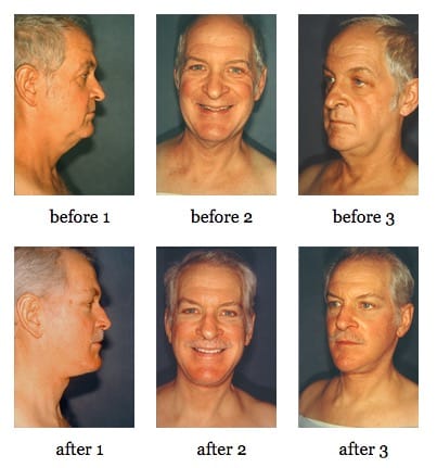 facelift before and after