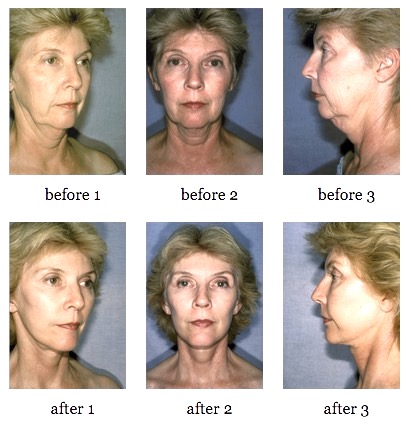 Female Facelift Before and After